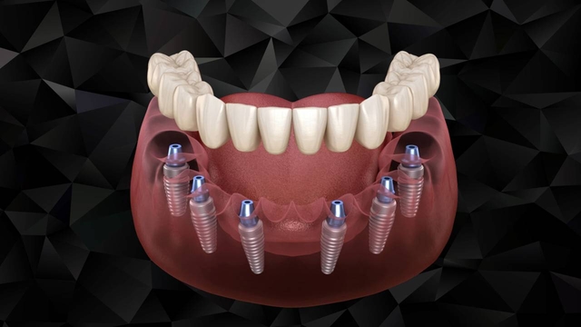 Có nên cấy ghép Implant không &#8211; Giải đáp từ chuyên gia