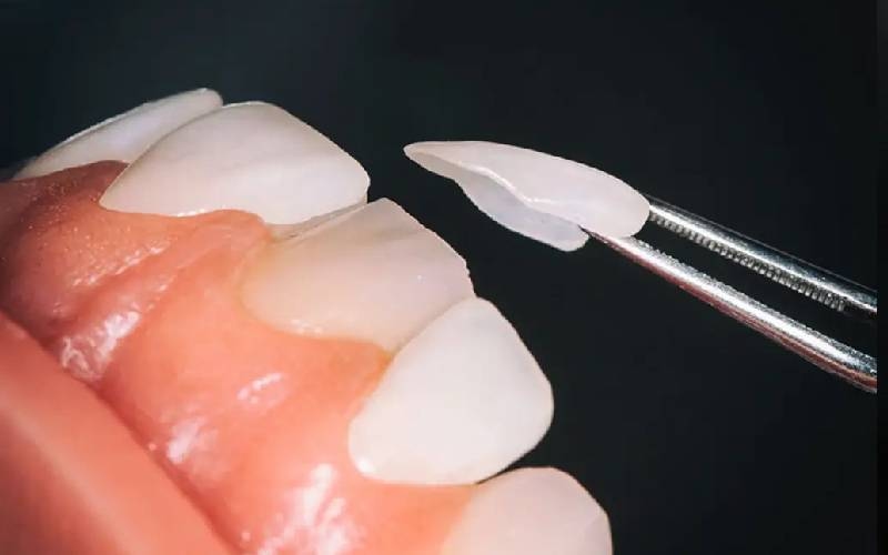 dán veneer răng dành cho những ai