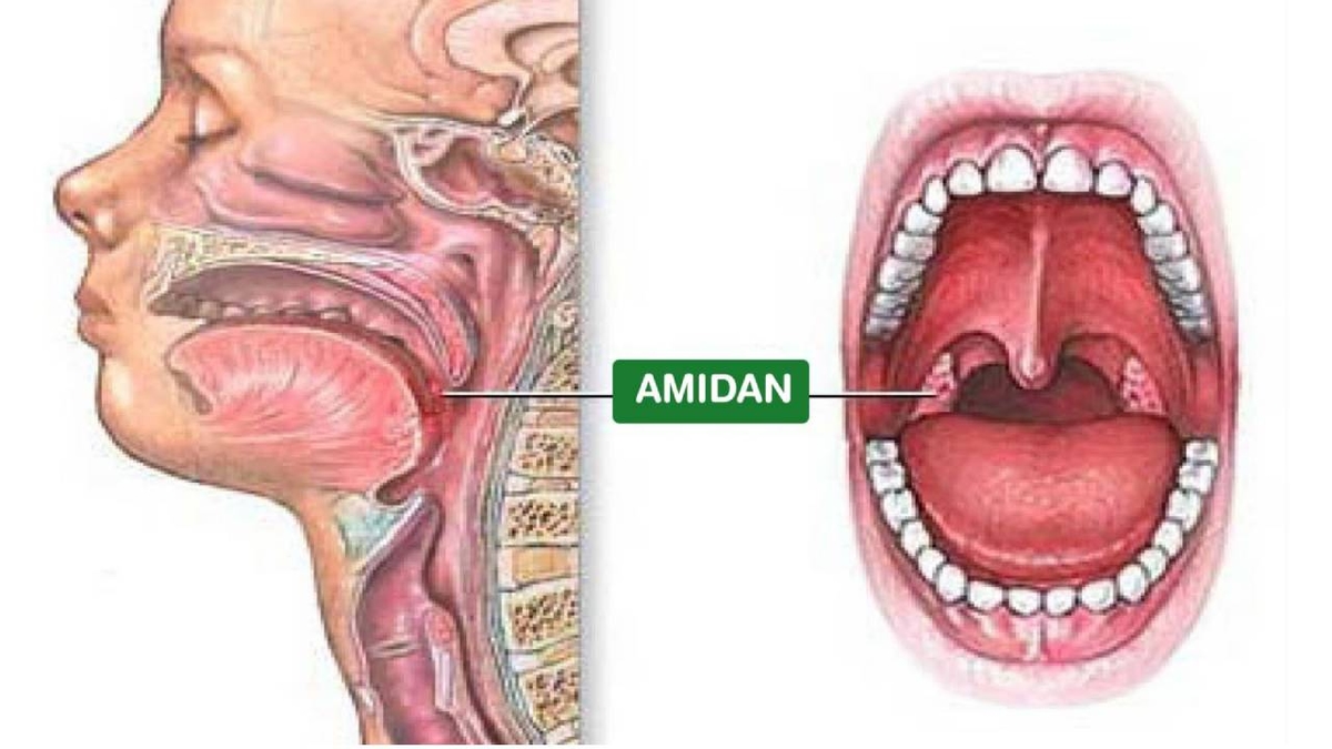 Điều trị viêm amidan &#8211; Phương pháp và những lưu ý