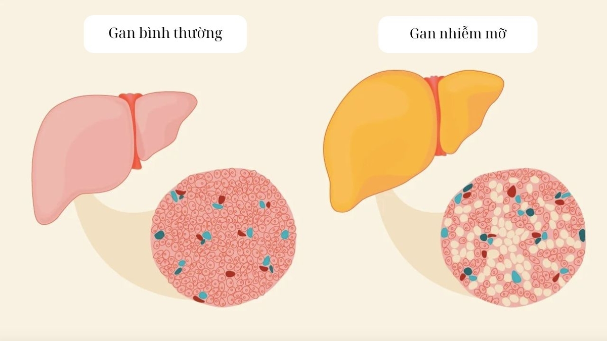 Gan nhiễm mỡ có triệu chứng gì và dấu hiệu nguy hiểm
