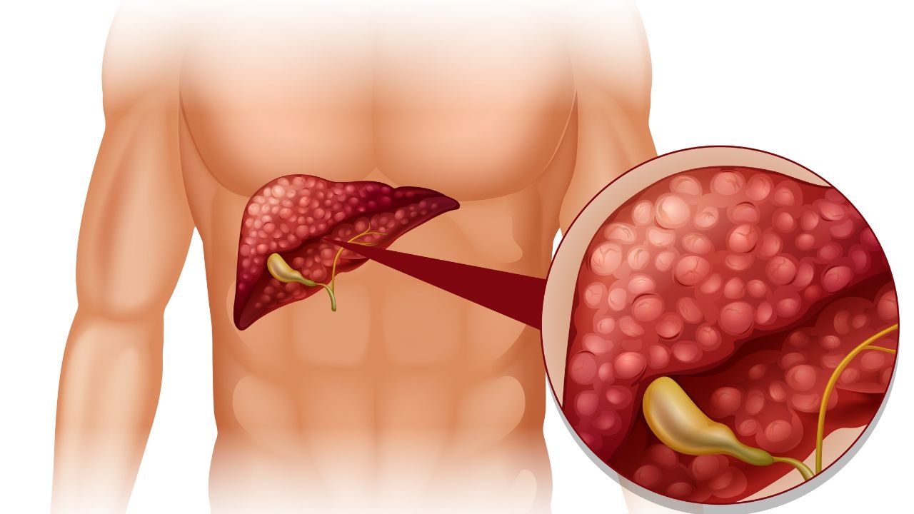 Những điều cần biết về viêm gan nhiễm mỡ không do rượu