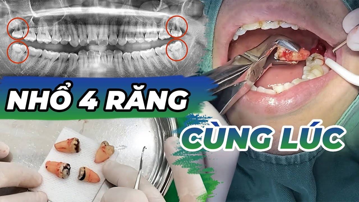 Nhổ 4 răng khôn cùng lúc &#8211; Những lưu ý cần thiết