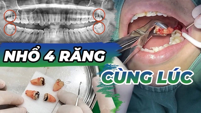 Nhổ 4 răng khôn cùng lúc &#8211; Những lưu ý cần thiết