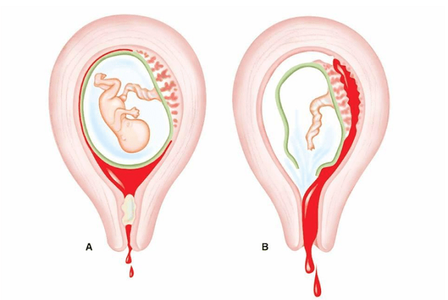 Vỡ tử cung là một trong những tai biến sản khoa vô cùng nguy hiểm