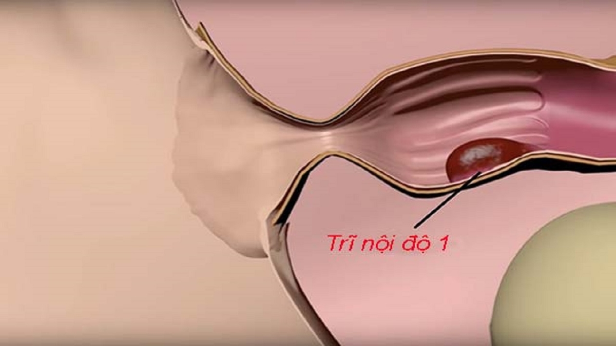 Trĩ nội biểu hiện thế nào &#8211; Dấu hiệu nhận biết và cách điều trị