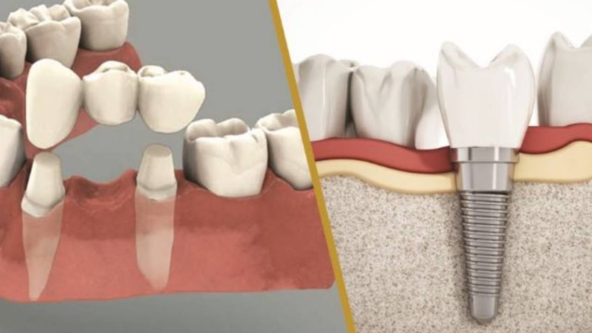 Trồng răng giả &#8211; Các phương pháp và những thông tin cần biết