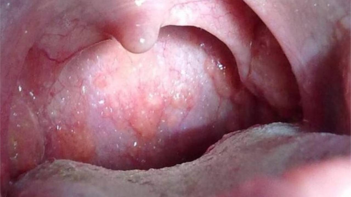 Viêm họng hạt mạn tính &#8211; Những điều bạn cần biết