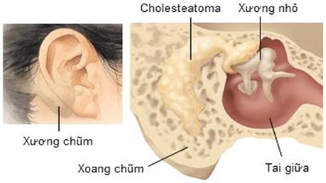 Viêm tai xương chũm có cholesteatoma &#8211; Bệnh lý cần cảnh giác