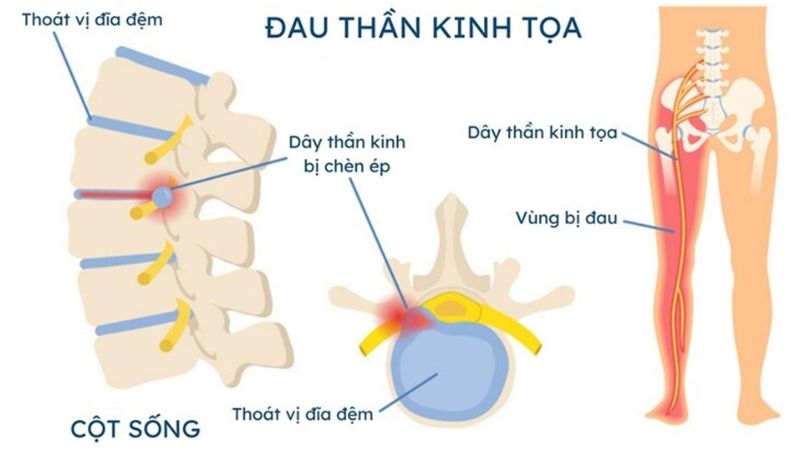 Tình trạng đau dây thần kinh tọa là gì?