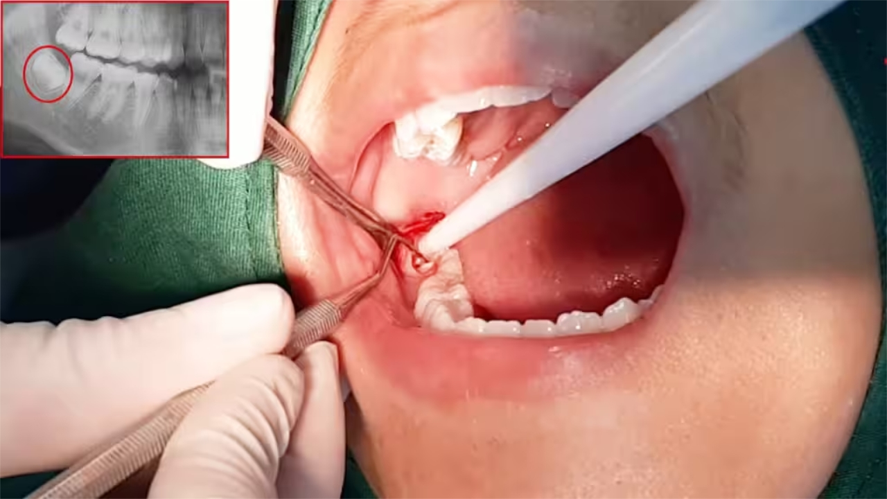Nhổ răng khôn nguy hiểm không và giải đáp