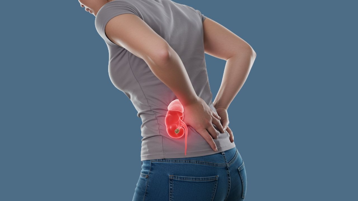 Thận ứ nước gây đau lưng có liên quan gì đến sỏi thận?
