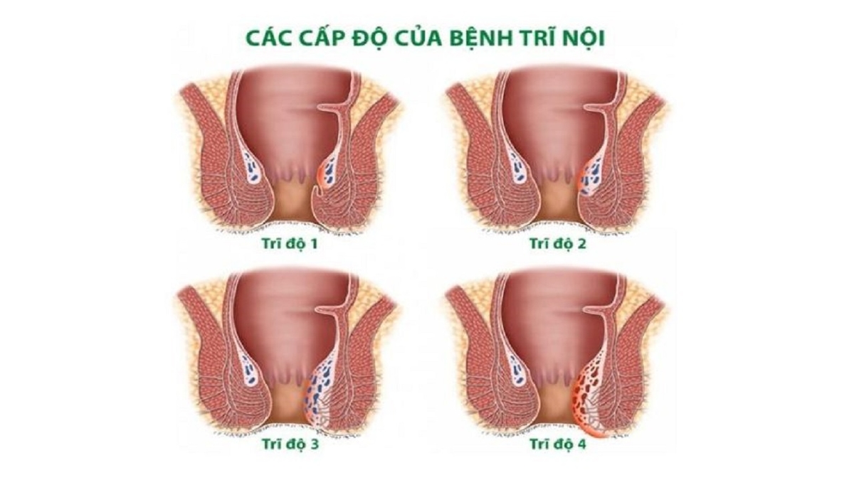 Lý do bị trĩ nội – Dấu hiệu nhận biết và điều trị sớm