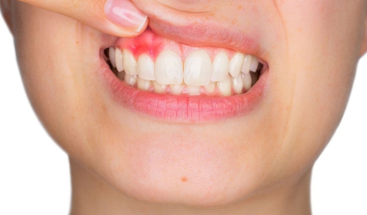 Dấu hiệu viêm lợi sớm và thời điểm cần điều trị