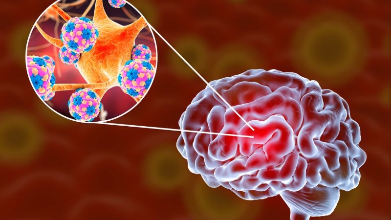Sa sút trí tuệ thể tiến triển do đâu?