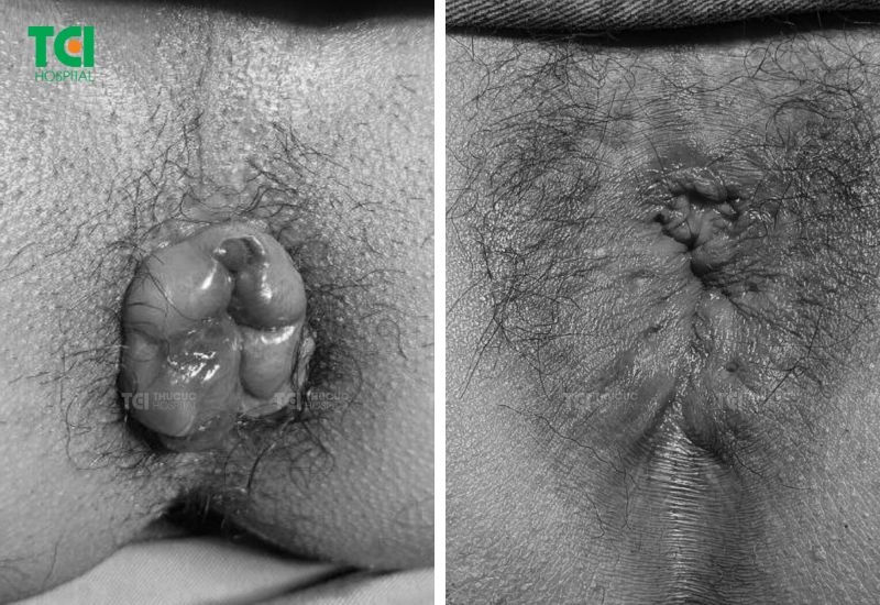 Hình ảnh hậu môn trước - sau khi điều trị trĩ bằng Laser Diode