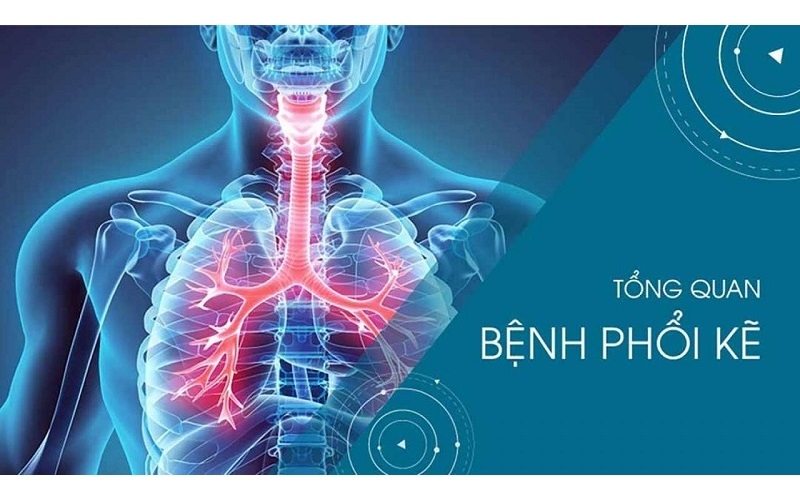 Viêm phổi kẽ 