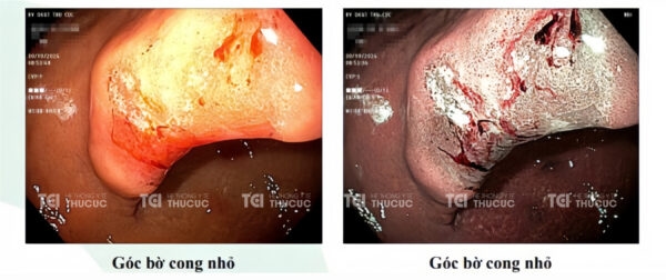 Kết quả nội soi của bà V tháng 10/2024: Vết loét vẫn còn