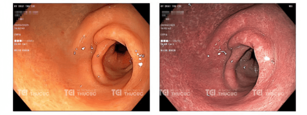 Kết quả nội soi của bà V tháng 3/2025: Ổ loét đã khỏi