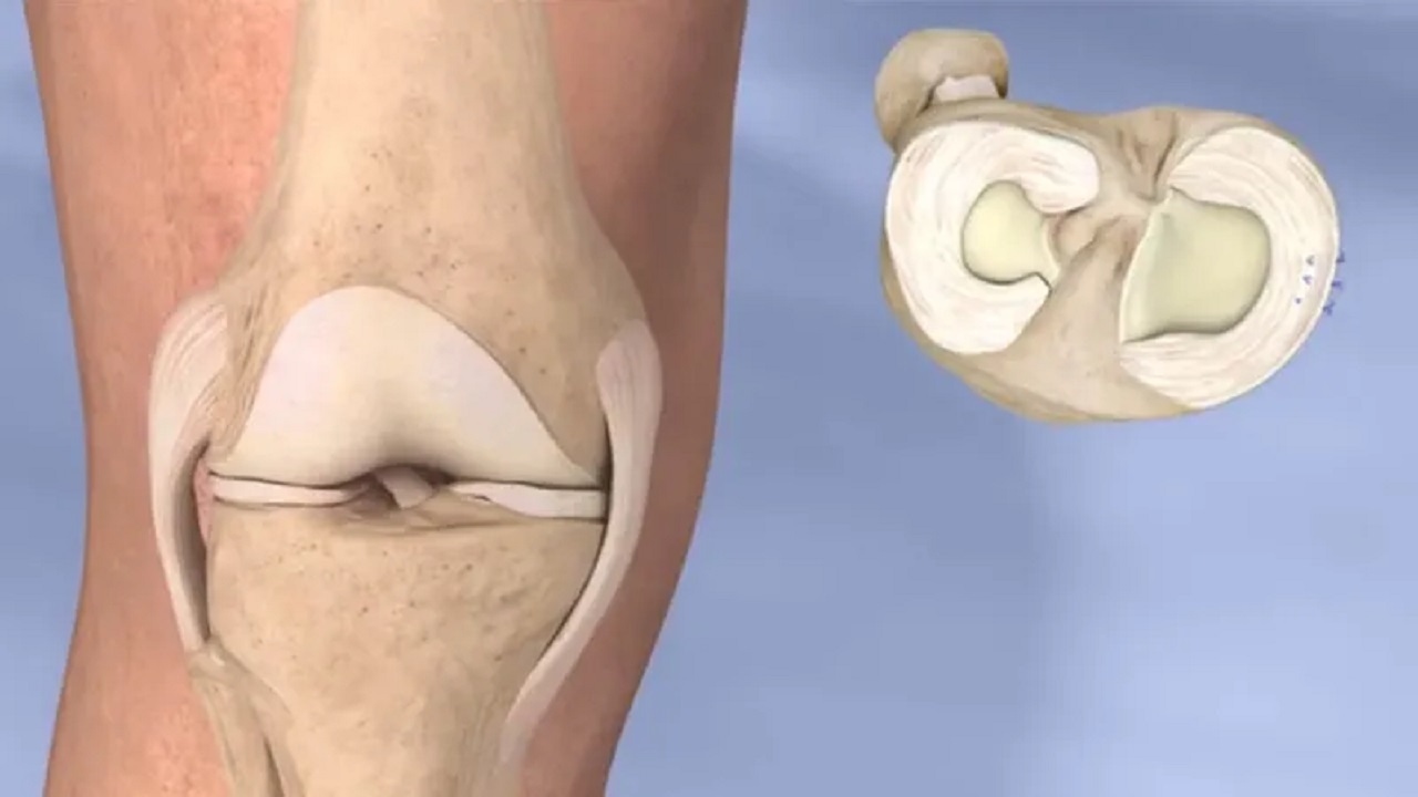 Cách chữa rách sụn chêm đầu gối hiệu quả
