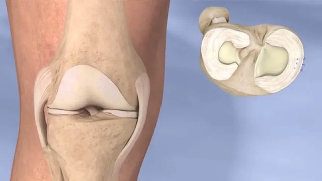 Cách chữa rách sụn chêm đầu gối hiệu quả