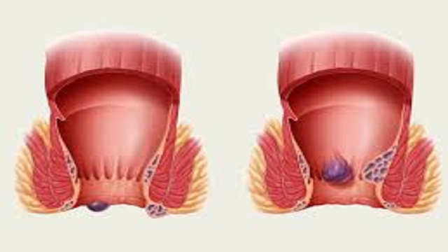 Khi nào cần khám bệnh trĩ &#8211; Dấu hiệu không thể bỏ qua