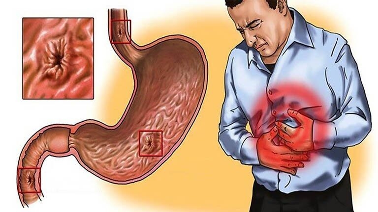 Loét dạ dày có thể gây nhiều biến chứng nguy hiểm.