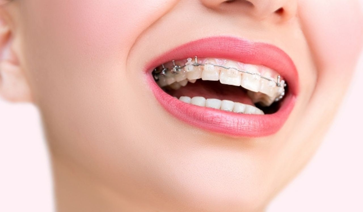 Những sai lầm cần tránh khi niềng răng vẩu để đạt kết quả tốt nhất
