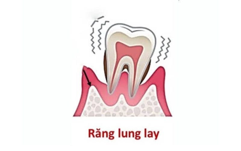 liệu Răng lung lay có giữ được không