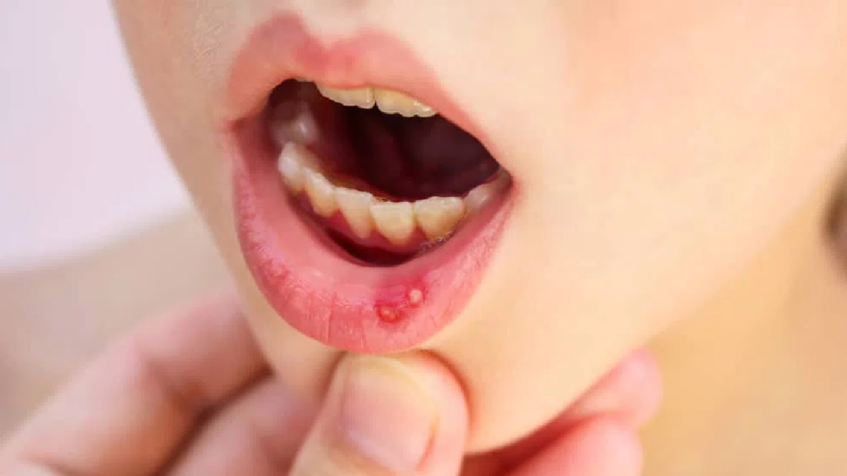 Thuốc chữa nhiệt miệng và lưu ý khi sử dụng