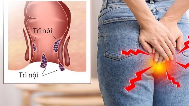 Trĩ nội biểu hiện thế nào – Nhận biết và điều trị hiệu quả