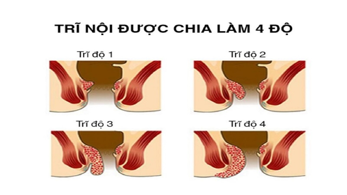 Những điều cần biết về trĩ nội cấp độ 2 và điều trị