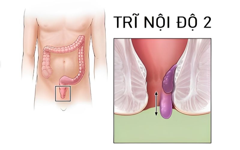 Trĩ nội độ 2 là như thế nào