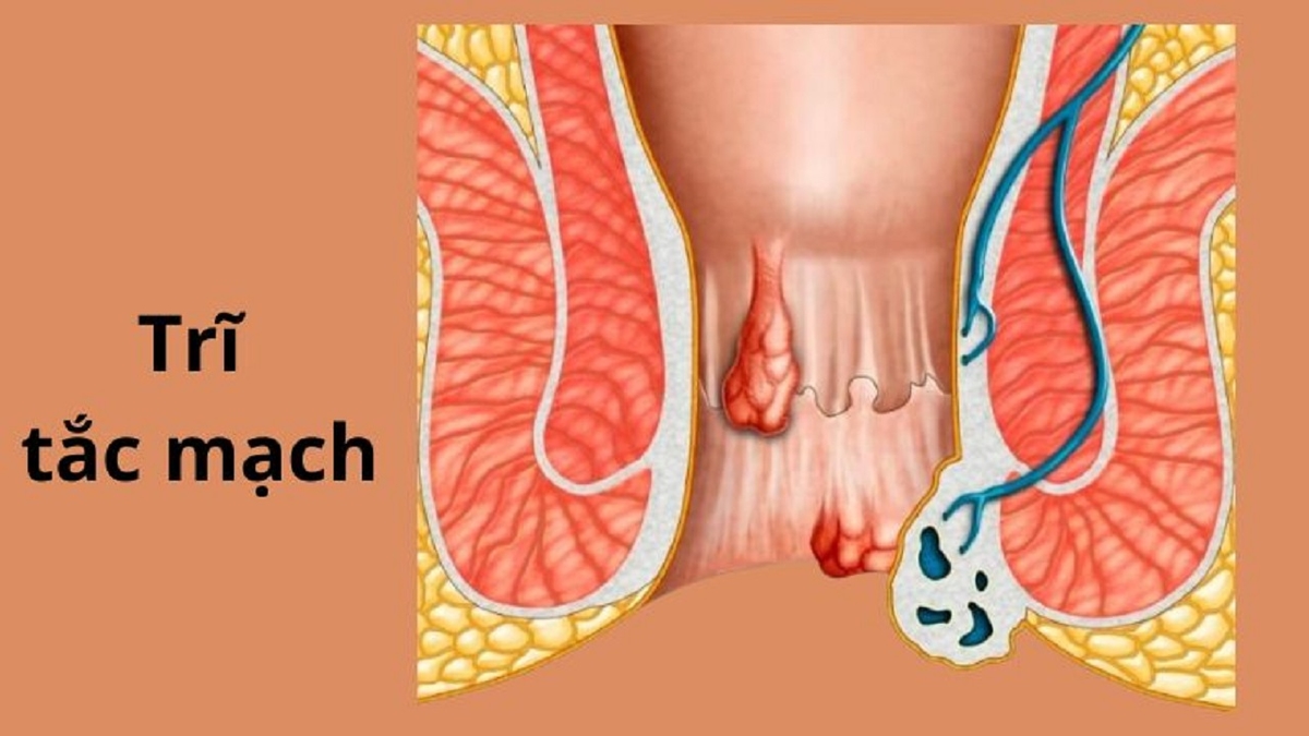 Trĩ nội tắc mạch: Biến chứng nguy hiểm không thể xem thường