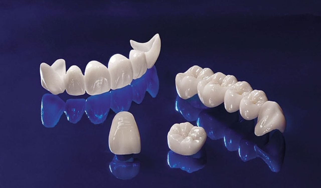 Ưu điểm nổi bật của trồng răng sứ Titan trong phục hình răng