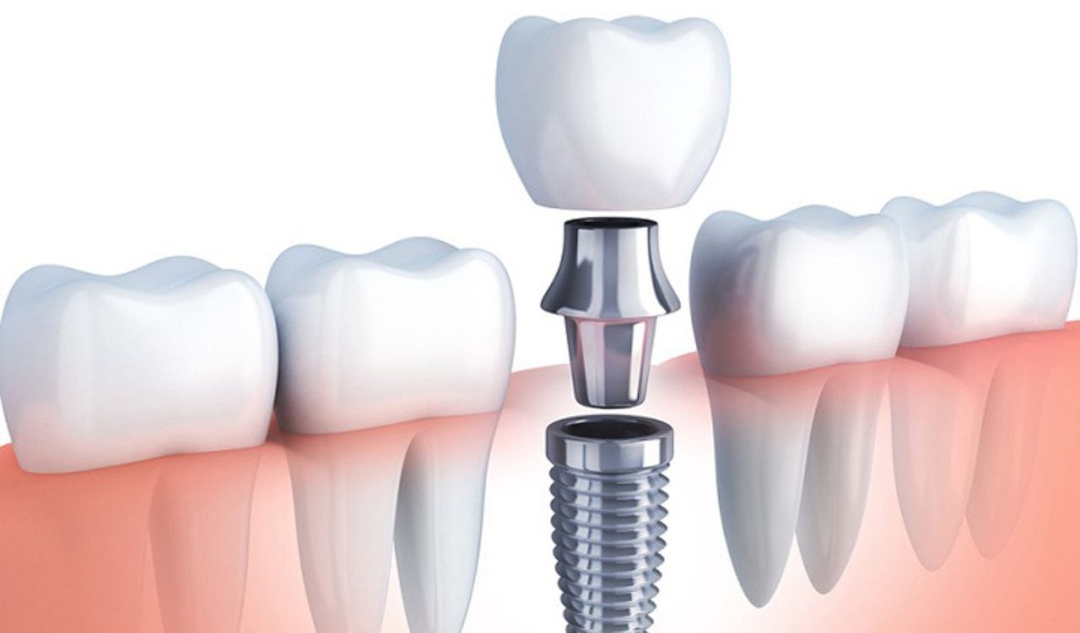 9 Lợi ích vượt trội của phương pháp trồng răng thật hiện đại