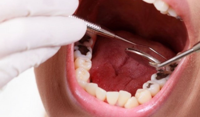 Tầm quan trọng của vệ sinh răng sâu trong chăm sóc răng miệng