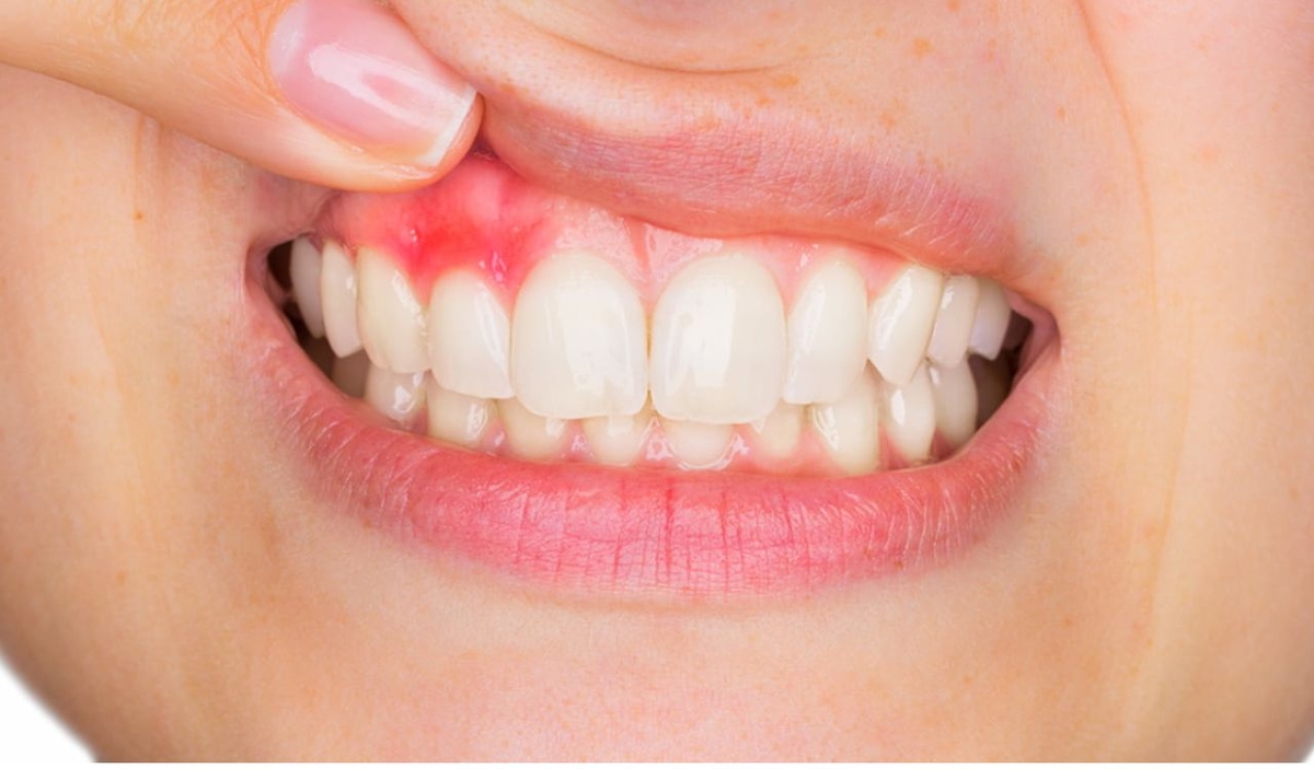 Viêm lợi chân răng : Nguyên nhân và cách điều trị hiệu quả