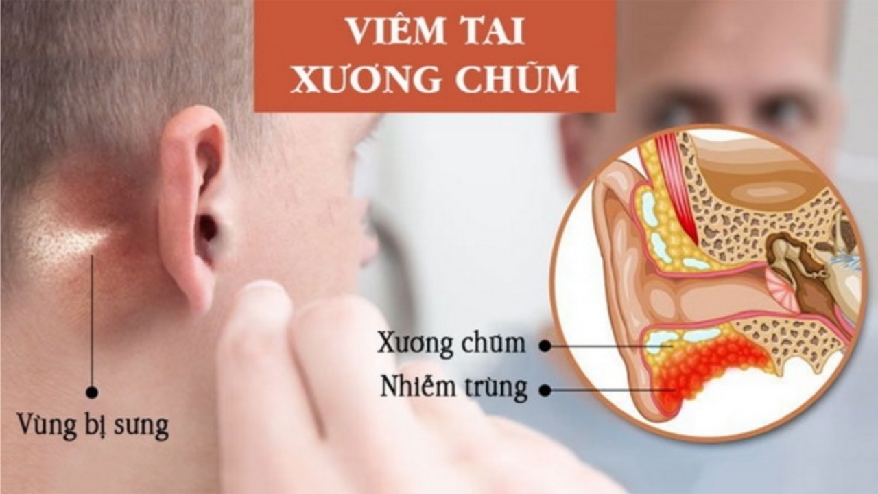 Viêm tai xương chũm &#8211; Bệnh lý cần cẩn trọng