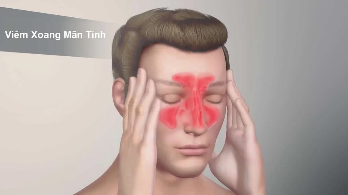 Viêm xoang mạn tính &#8211; Chẩn đoán và điều trị