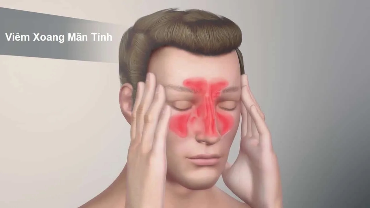 Viêm xoang mạn tính &#8211; Chẩn đoán và điều trị