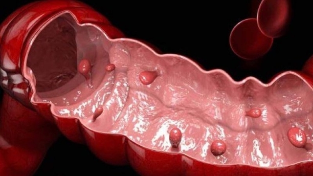 Polyp ở đại tràng: Nguyên nhân, triệu chứng và cách điều trị hiệu quả