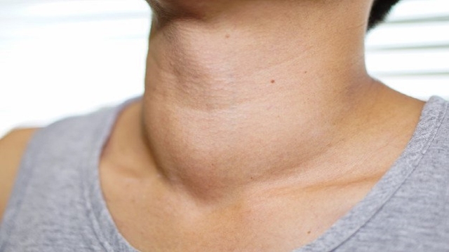 Những dấu hiệu cảnh báo bị bệnh cường giáp bạn không nên bỏ qua