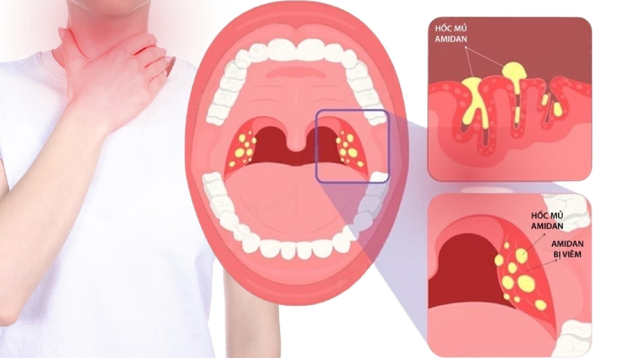 Bị viêm amidan &#8211; Dấu hiệu và những lưu ý cần thiết
