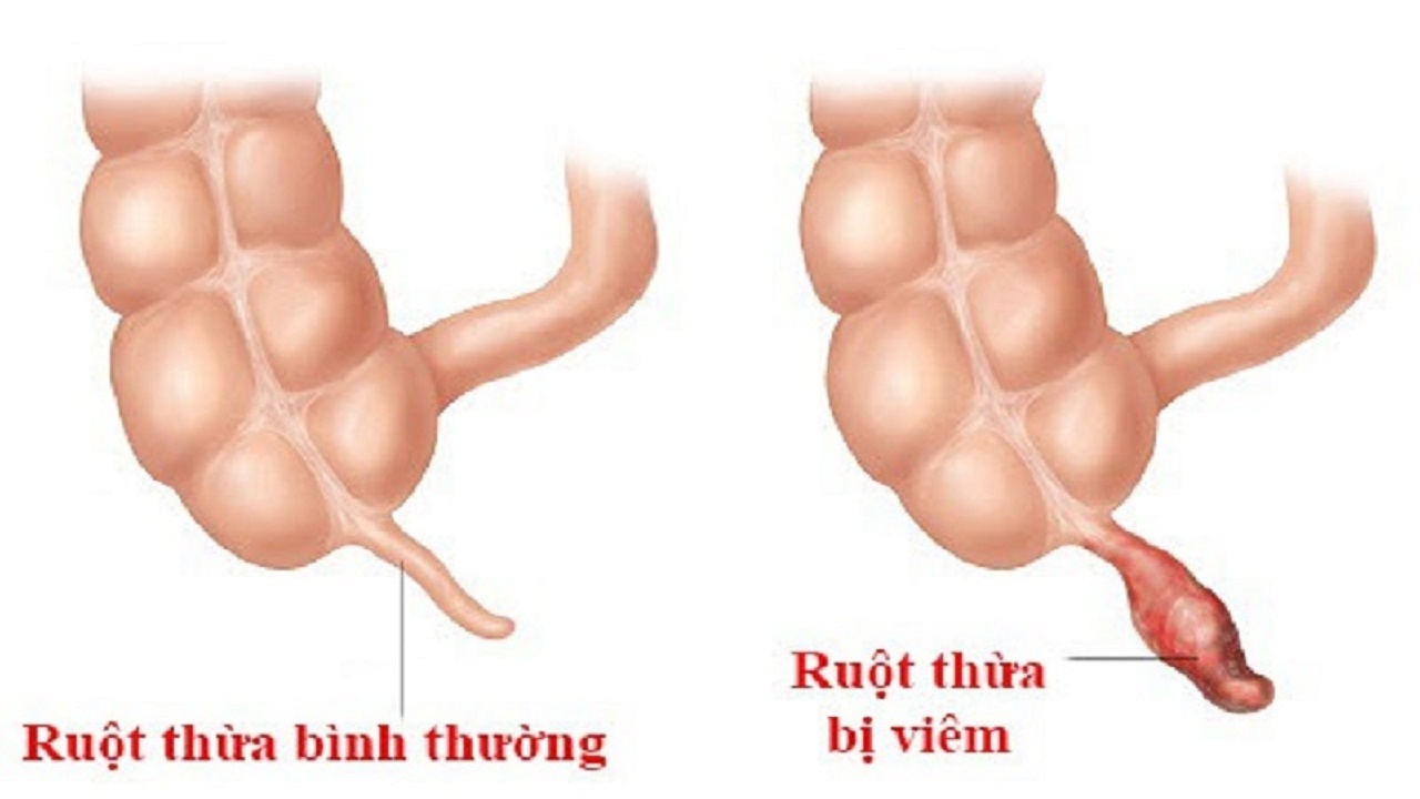 Bị viêm ruột thừa cần được xử trí kịp thời