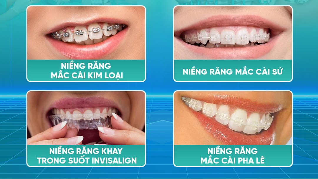 Tìm hiểu về các cách niềng răng