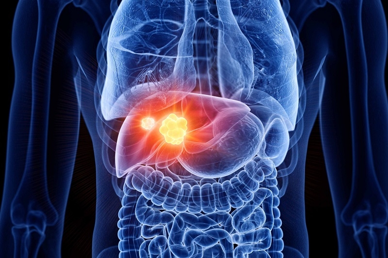 U máu gan (tên tiếng anh là hemangioma liver ) là một khối u trong gan không ung thư (lành tính)