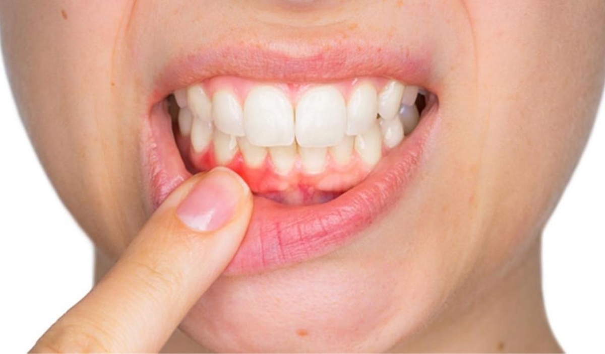 Đau viêm lợi: Nguyên nhân, dấu hiệu và cách cải thiện hiệu quả