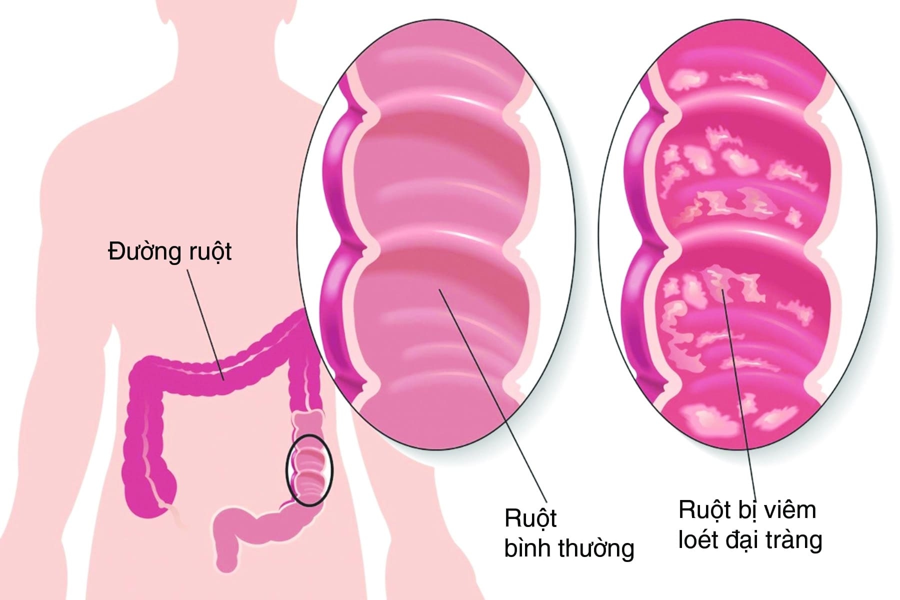 Điều trị viêm đại tràng: Tổng quan, phương pháp và lưu ý cần thiết
