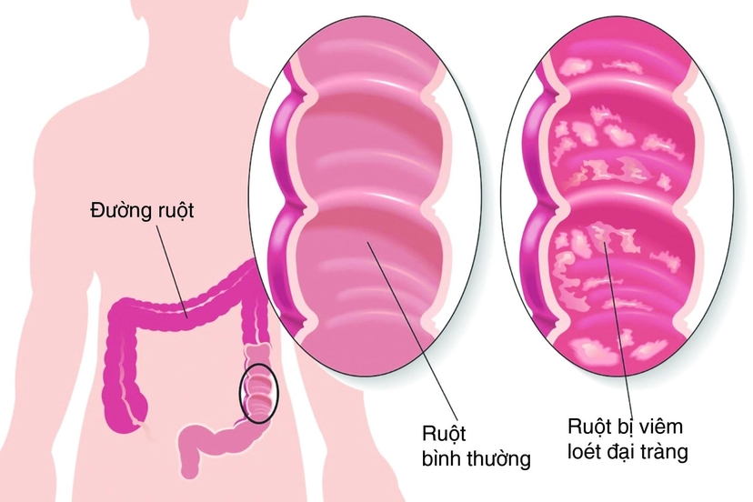Điều trị viêm đại tràng: Tổng quan, phương pháp và lưu ý cần thiết
