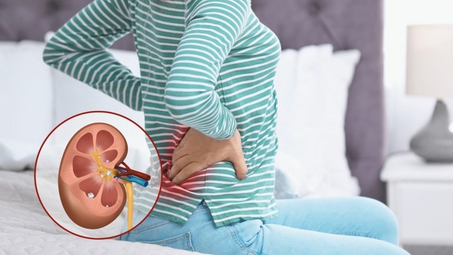 Giãn đài bể thận ở người lớn do sỏi niệu quản và cách khắc phục